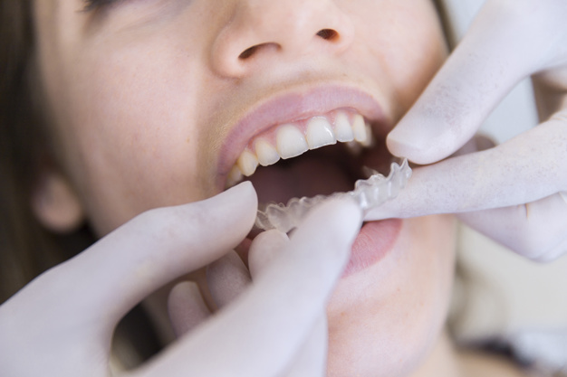 Invisalign Orthodontic Treatment