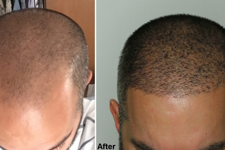 Who is Suitable for a FUE Hair Transplant?