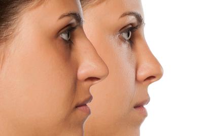 non surgical nose job in Islamabad