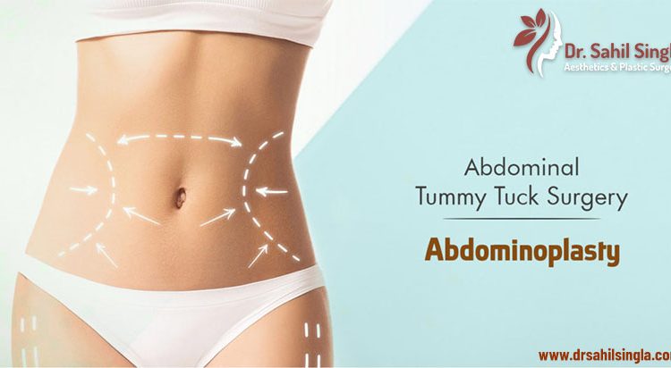 abdominoplasty in Delhi