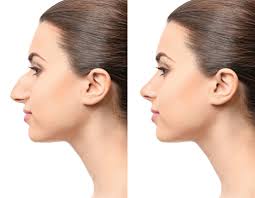 best rhinoplasty in dubai