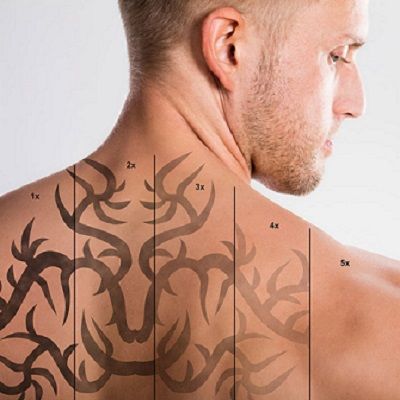 Laser Tattoo Removal in Dubai