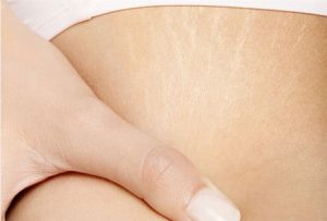 Stretch Marks Removal in Dubai