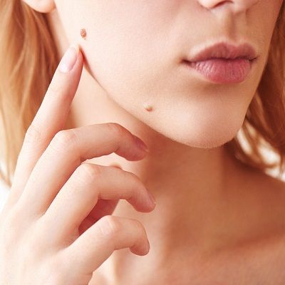 Skin Lesion Removal Dubai