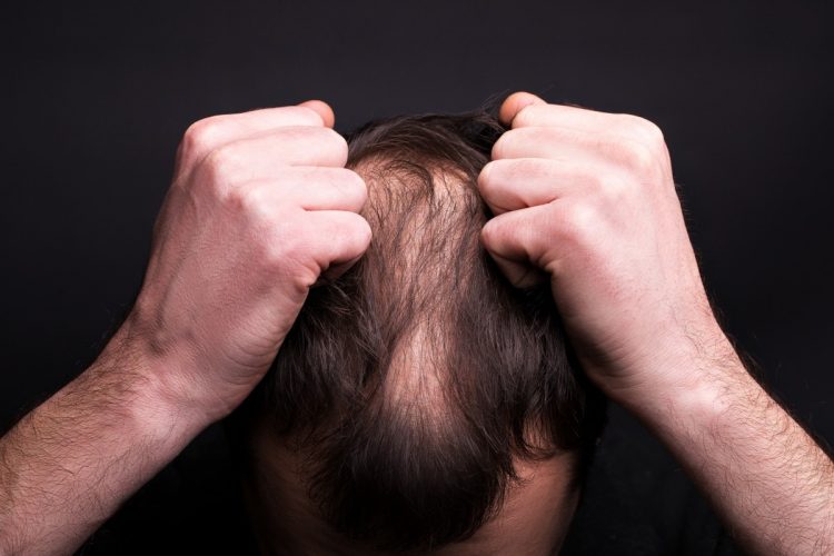 Finasteride for Hair Loss in Dubai