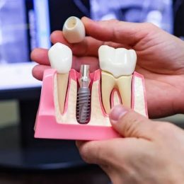 Know The Real Importance Of Dental Implant Experts