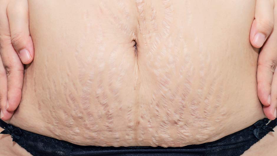 Stretch Marks 101    Article Source: http://EzineArticles.com/6664767